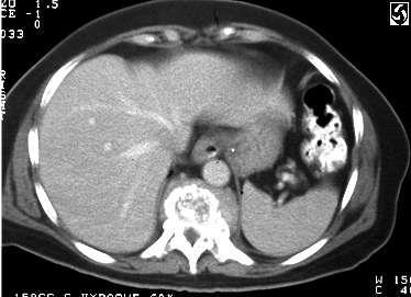 CT-scan Most of boney spinal pathology 1. Trauma 2. Osteomylitis 3. Infection 4. Tumors 5.