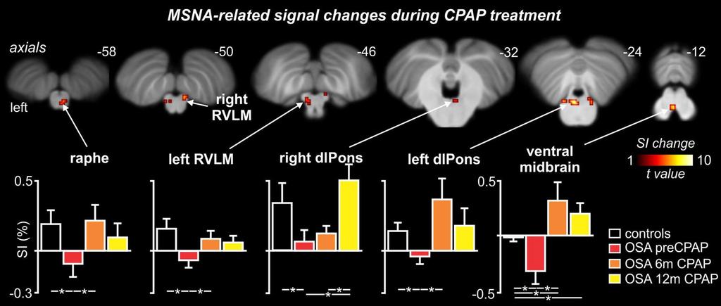 CPAP effects on Muscle SNS Activity and MRI SNS Brainstem Activity Henderson et al.