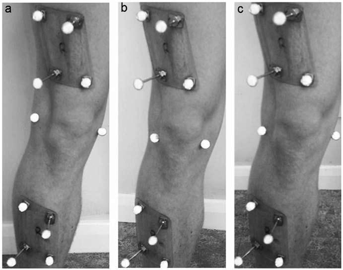 186 Thewlis, Richards, and Bower (2002) noted that a 15 rotation of the tibial coordinate system can result in large differences in sagittal and coronal plane knee moments, for what they deemed to be