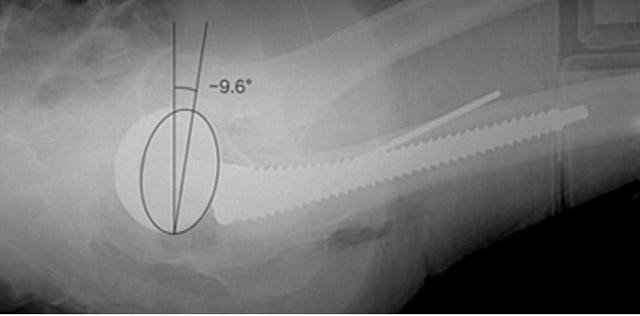 318 S.W. Park, J.H. Park, S.-B. Han, et al. Fig. 5. (A) The acetabular cup was 9 retroverted in the initial portable. (B) The reinserted cup was 18.5 anteverted in the confirmed portable.