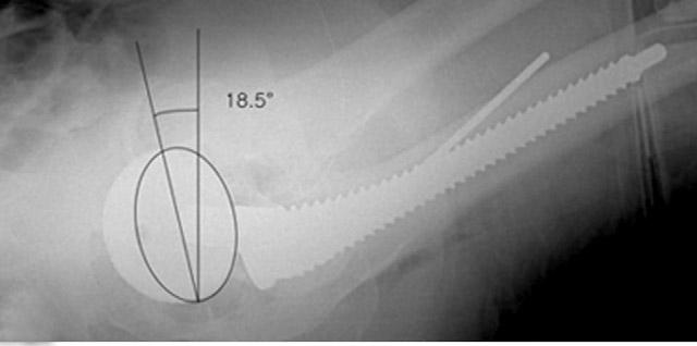 A B C operative estimations of acetabular version are of limited accuracy, and furthermore, little information is available concerning the accuracy of component placement.