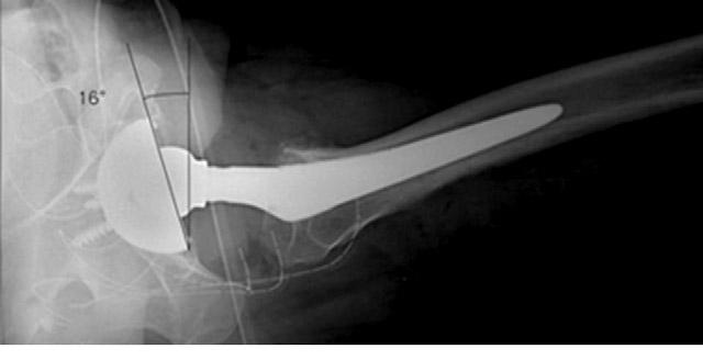 The first such study in total hip arthroplasty was conducted by McLaren, who used the wire ring in the Charnley-Muller prosthesis to calculate version (9).