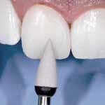 This simplifies polishing, allowing highly aesthetic restorations to be performed in next to no time.