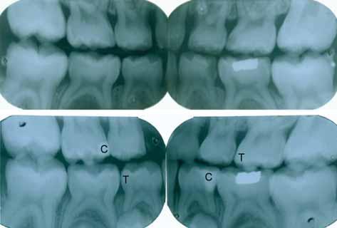 CLINICAL SIGNIFICANCE OF GLASS IONOMER FLUORIDE FIG. 2 - Initial (upper) and final (lower) radiographs show how the child s conservative needs were met.