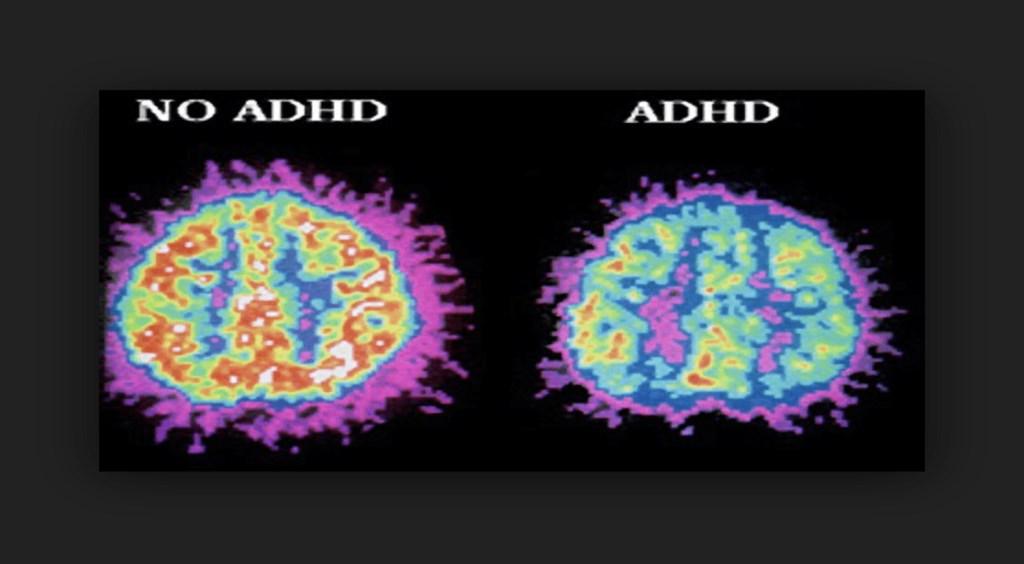 Pengaruh Makanan Terhadap ADHD Sedar atau tidak, makanan yang dimakan setiap hari mempengaruhi bukan sahaja kesihatan fizikal malah kesihatan mental seseorang.