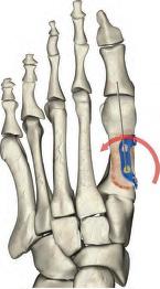 NOTE: If not using the C-arm, surgeon should visually make sure that the K-wire has proper purchase through the bottom metatarsal bone in order to ensure bi-cortical fixation of the distal 3.