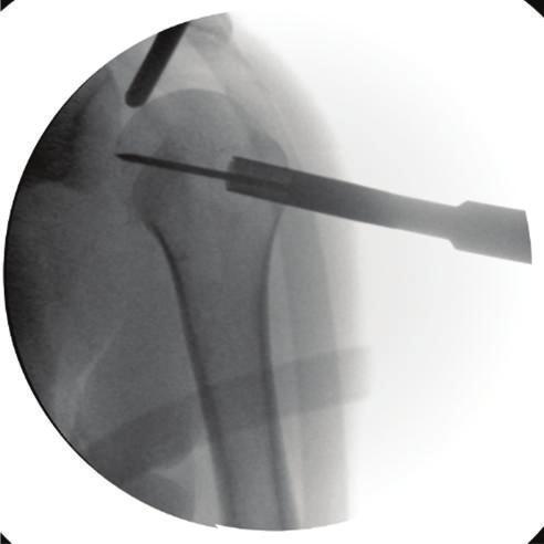 Through a lateral approach a k-wire was placed into the central defect of the Hill- Sachs lesion (Figure 2); it can be helpful to guide the k- wire by a tibial guide used in cruciate ligament surgery