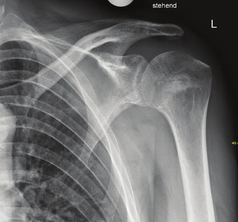 procedure showing an intact glenohumeral