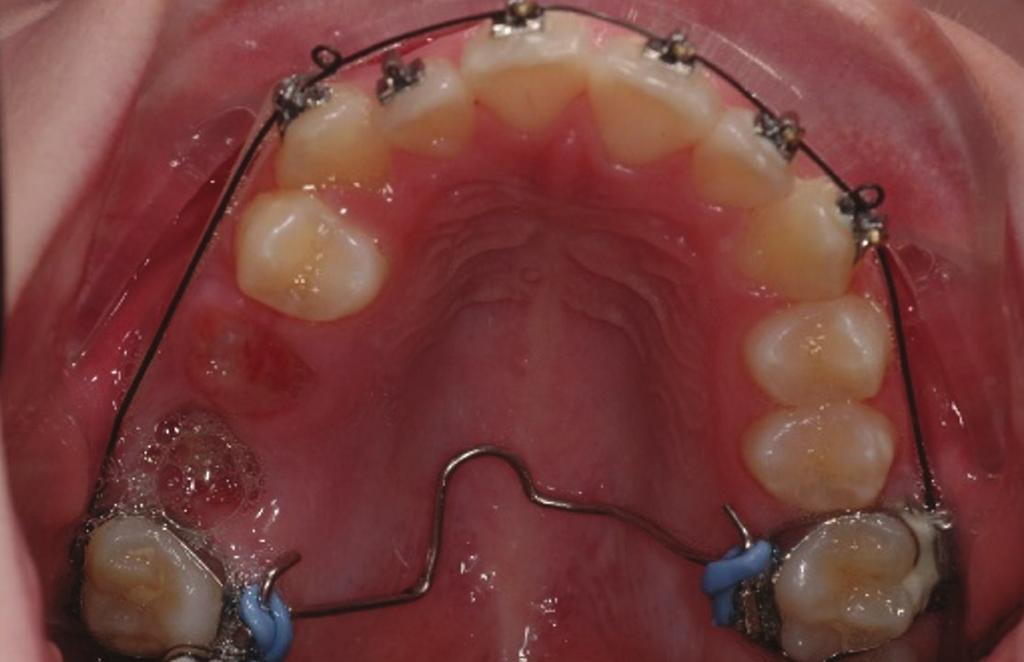 Case Reports in Dentistry 3 (a) (b) (c) (d) (e) (f) (g) (h) Figure 4: (a d)