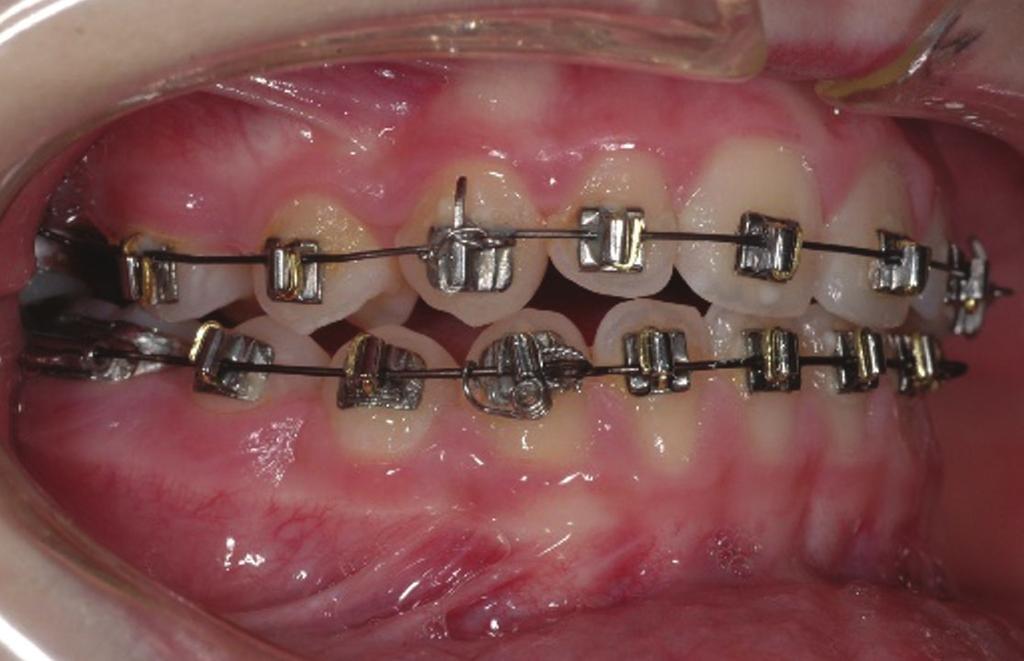 014-inch regular wire (Wilcock) was inserted in the anterior maxillary region