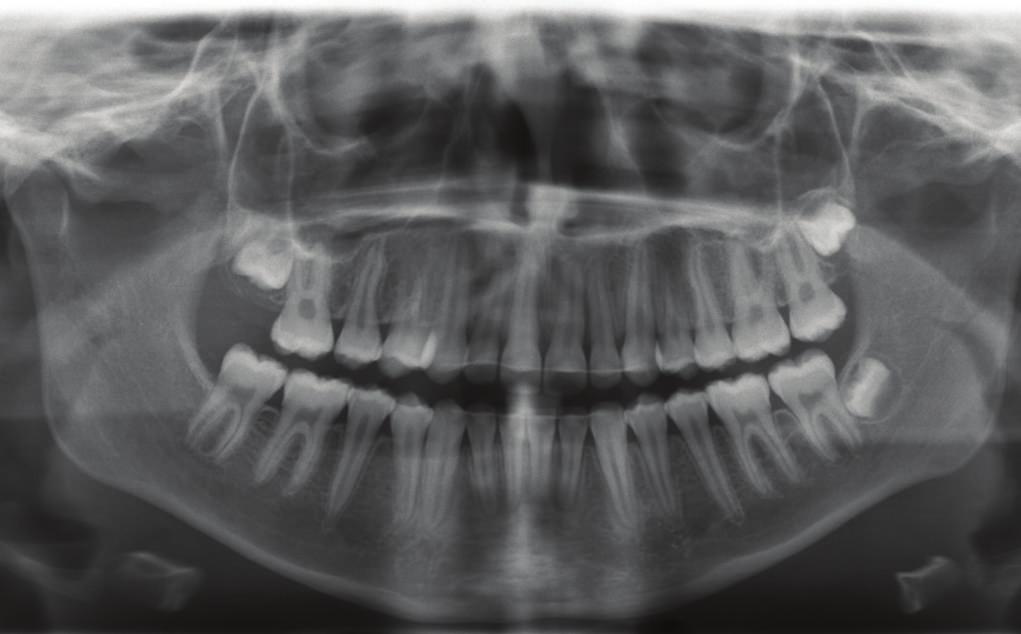 Anterior Our Class II subdivision technique led to good occlusal and esthetic outcomes, which were preserved