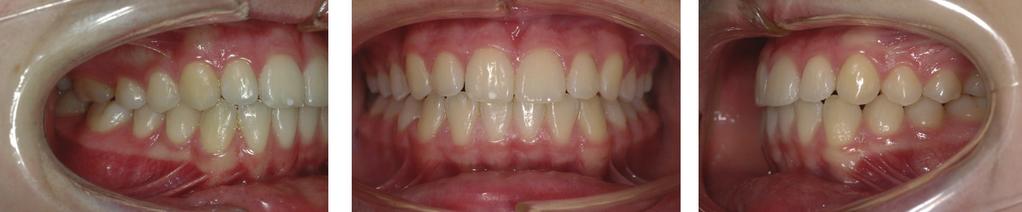 Longer treatment duration has been observed in asymmetric premolar extraction protocols [4, 5] compared to orthodontic therapy with either unilateral maxillary first molar extraction [6] or Herbst