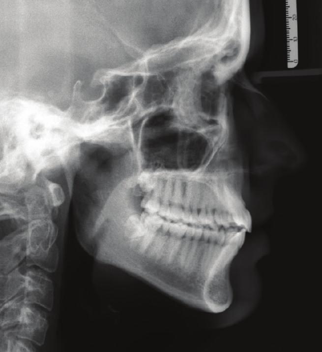 Nonetheless, with respect to the end molar occlusion, Class III in the original Class I side may be expected in Class II subdivision patients treated with fixed functional appliances [3].
