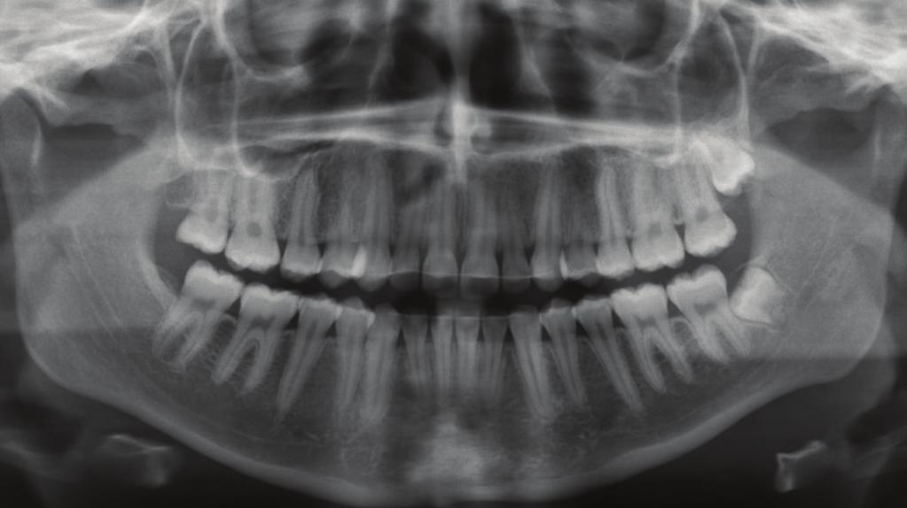 However, orthodontic mechanics including application of light elastic forces, anchorage bends, or delayed bonding of premolars during space closure may be integrated in the philosophy of contemporary