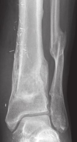 Persistent discharge for 3 years despite local excision, VAC