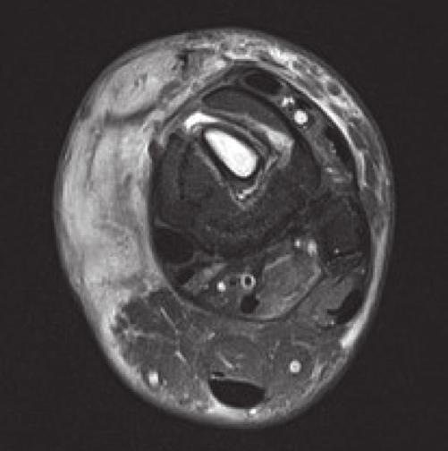 Pattern C - Halo" sign FIGURE 14: Follow-up T2 MRI at 12 weeks.