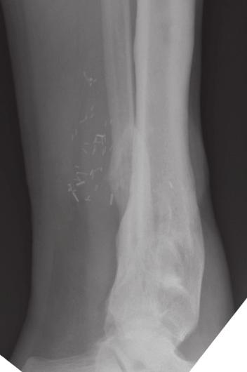 FIGURE 15: Follow-up radiograph at 7 months, showing progression of