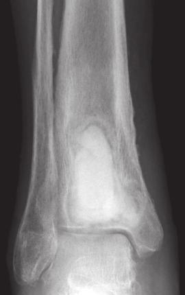 chronic osteomyelitis for 60 years with a