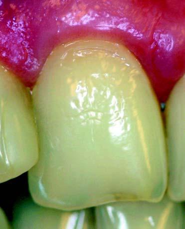 As erosive tooth wear is a multifactorial condition, preventive strategies has to be applied which account for chemical, biological and behavioral factors involved in the etiology and pathogenesis of