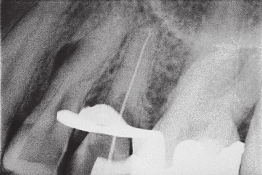 tooth. Also, note the instrument separation in the apical part.