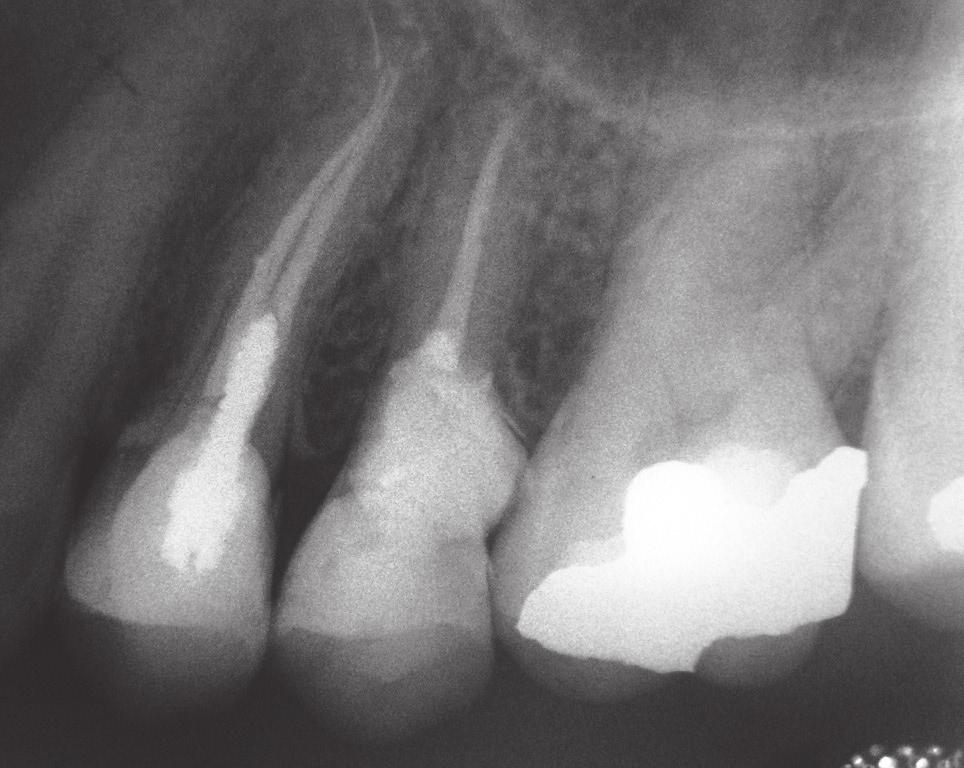 Also, the sealer extruded into the lateral canal of tooth 24 connecting the internal resorptive process with the external inflammatory