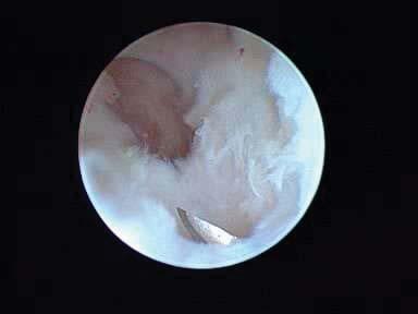 Technique First 34 gauge needle inserted from the RUD portal into the meniscal part of TFCC with