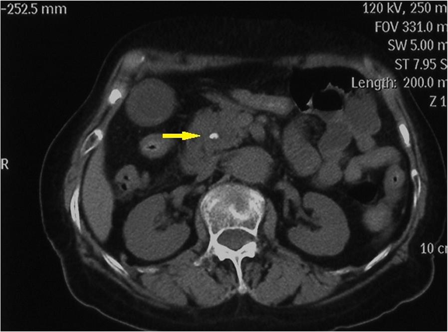 Zhu et al. BMC Gastroenterology (2018) 18:163 Case presentation A 75-year-old woman was admitted to the hospital with abdominal pain, nausea and vomiting for 3 days.