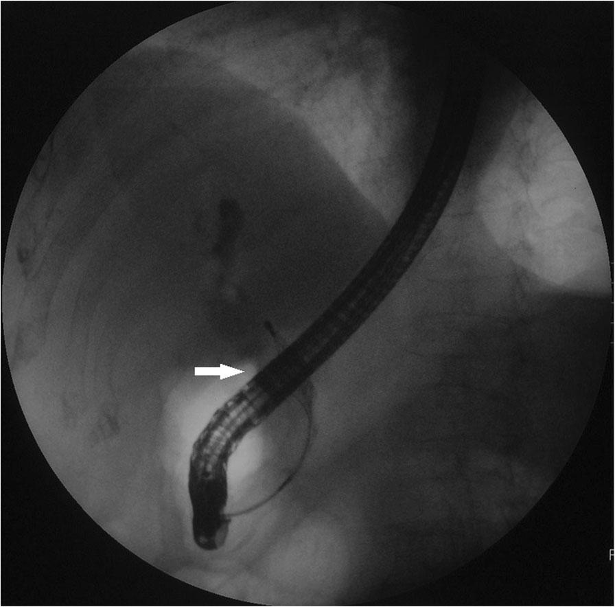Zhu et al. BMC Gastroenterology (2018) 18:163 Page 3 of 5 Fig. 4 A repeated ERCP revealed a dilated common bile duct with a long filling defect.