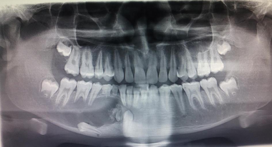 Figure 4 Panoramic radiograph of the patient revealed predominantly radiolucent lesion with areas of opacification visible extending from right mandibular lateral incisor to second molar, Impacted