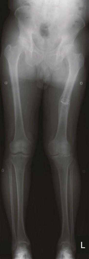 2 Case Reports in Orthopedics (a) (b) (c) (d) Figure 1: Case 1: preoperative anteroposterior standing radiograph (a) showed an extra-articular valgus deformity (11 ) in the femoral shaft.