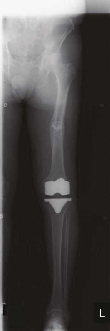 After excision of the marginal osteophytes and cruciate ligaments, two pins were inserted in the distal femur and proximal tibia to connect infrared intraoperative device, which can send anatomical