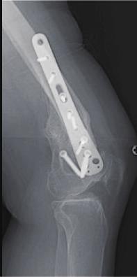 is not feasible, simultaneous or staged corrective osteotomy should be considered.