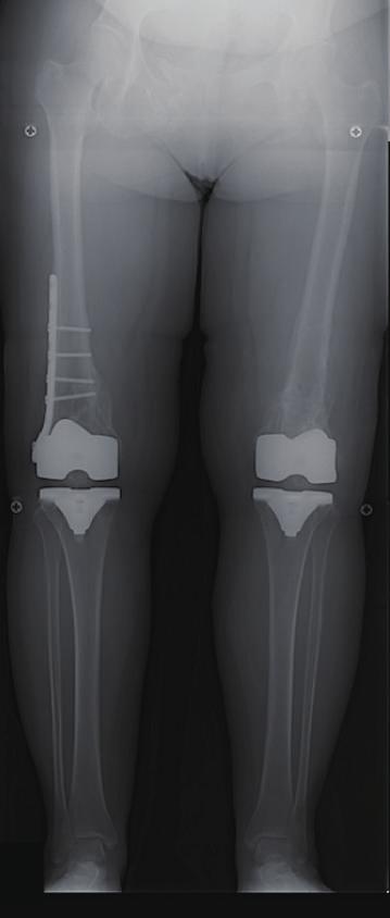 In the left knee of the second case, the distal femur shifted laterally and posteriorly. Thus traditional intramedullary guide cannot be used in such cases [7].