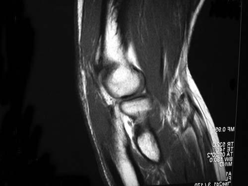 A, sagittal MR image demonstrating thickened, irregular plica (arrow). B, sagittal MR image of a normal elbow.