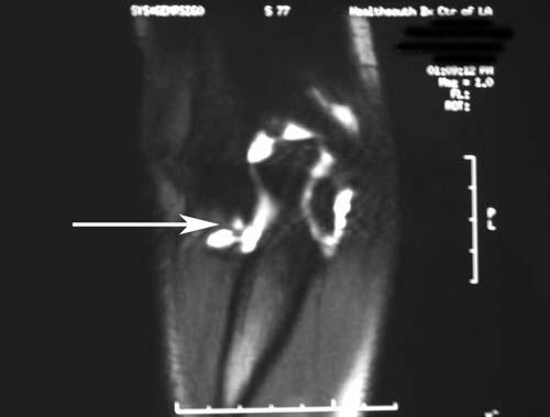 E, axial MR image of an elbow with posterolateral, thickened, abnormal plica (arrow).