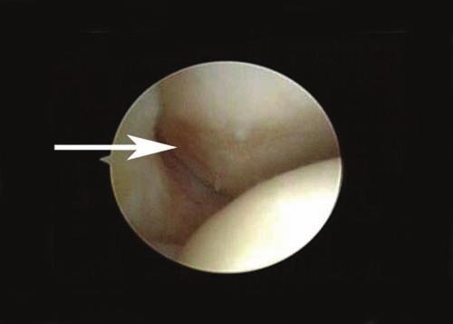 Vol. 34, No. 3, 2006 Lateral Synovial Plicae in Throwing Athletes and Golfers 441 A A B B Figure 3. Arthroscopic images of the radiocapitellar joint viewed from the posterior portal.
