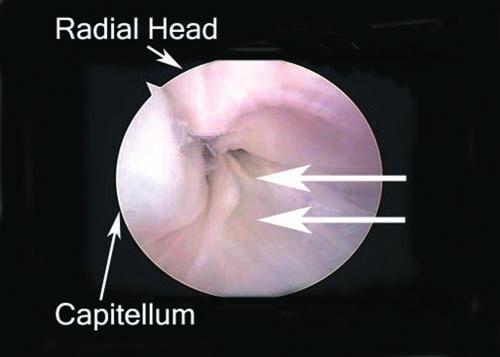 Arthroscopic images of the radiocapitellar joint viewed from the posterolateral portal. A, impingement of the joint caused by a thickened, hypertrophic plica (double arrows).