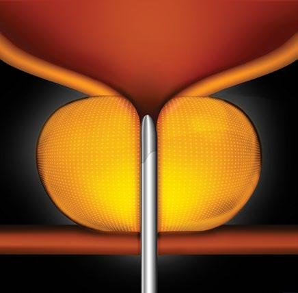 Bladder Prostate STEP 2 Small UroLift Implants are permanently placed to lift or hold the enlarged prostate tissue out of the way and