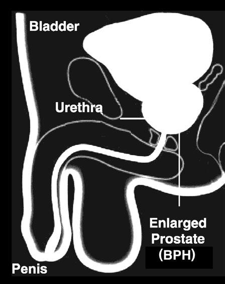 As the prostate enlarges, it presses on and blocks the urethra, causing bothersome urinary symptoms.