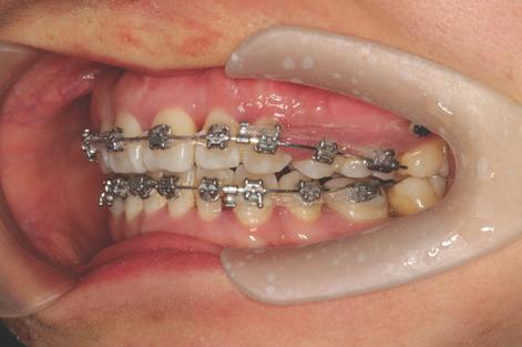 The objective of this paper is to enlighten the uses, types, advantages and disadvantages of miniscrews which are utilized to acquire temporary but complete anchorage for orthodontic operation.