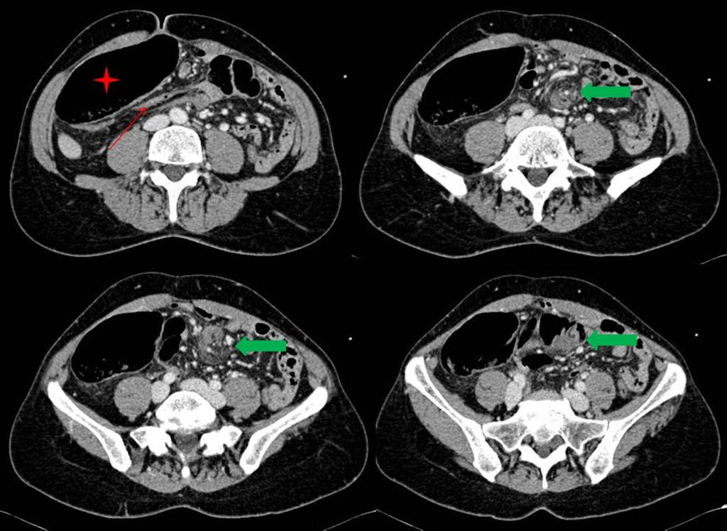 Fig. 7: Cecal volvulus. Axial contrast-enhanced CT images show the whirl sign (green arrows). Red star marks dilated cecum in the right lower abdomen.