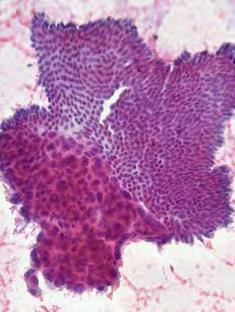 Pancreatoblastoma