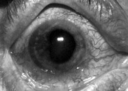 Constriction Prostaglandins: Latanoprost (PGF2α) Outflow Opioids (oral or intravenous) Pinpoint pupils Eye - Horners Syndrome Destruction of Sympathetic innervation to the