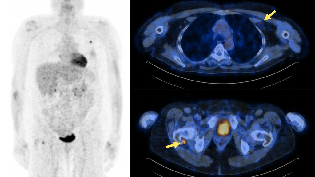 Vereos Digital PET/CT imaging combined with IntelliSpace app enabling precision diagnosis and oncology therapy planning 9 Industryleading, diagnostic confidence small lesion detectability and