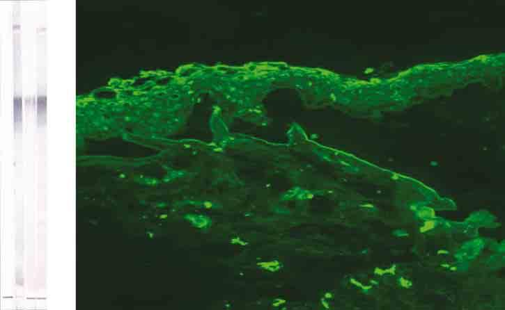 epidermis from the underlying dermis., Direct immunofluorescence study shows IgG with a strong linear deposition along the basement membrane zone.
