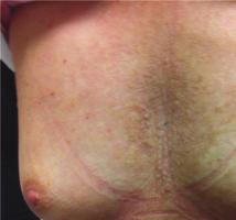 Case Reports in Dermatological Medicine 3 Figure 3: Skin features after 1 month. Figure 4: Skin features after 6 months.