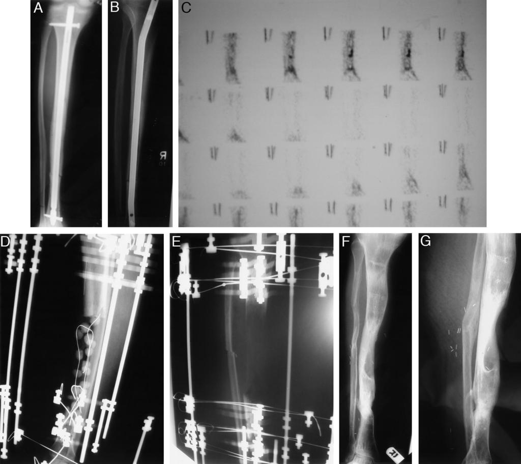 Treatment of Infected Tibial Nonunions 731 Fig. 1. Patient 5. (A) Anteroposterior X-ray at presentation, with intramedullary nail in place.