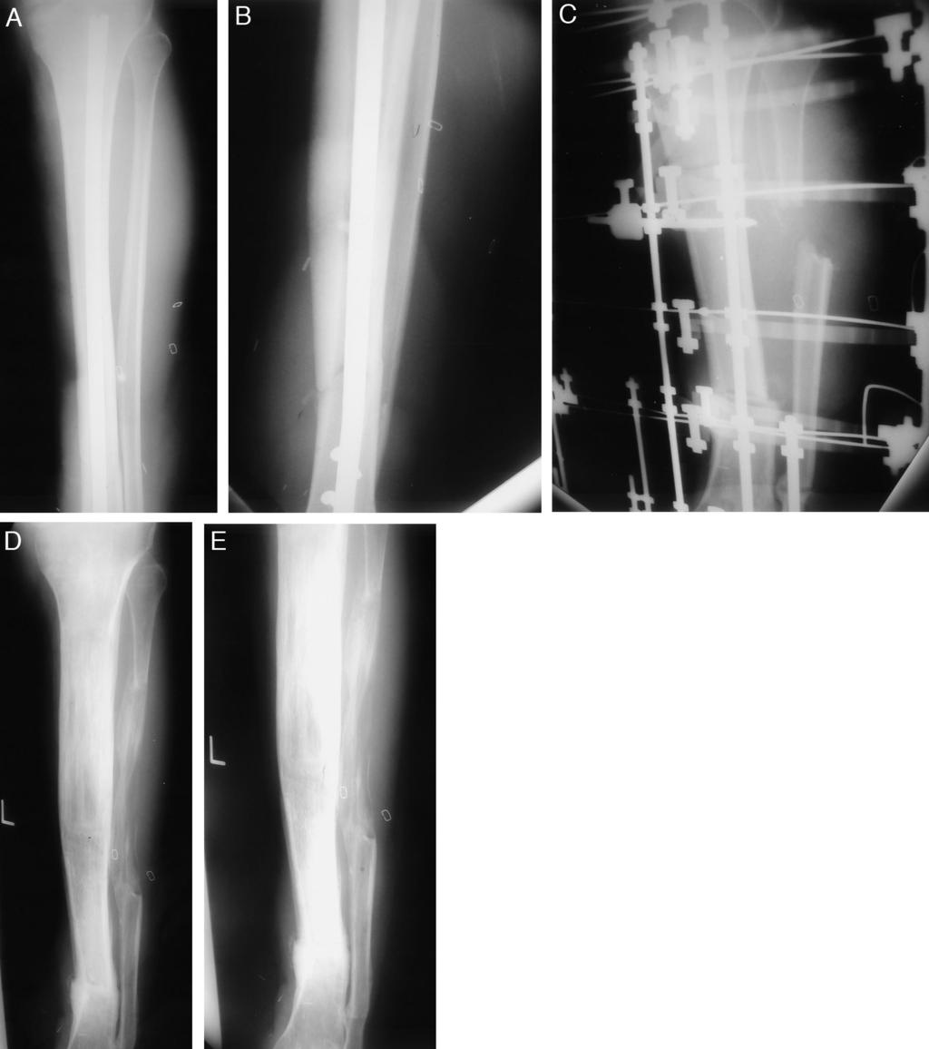 732 Treatment of Infected Tibial Nonunions Fig. 2. Patient 8. (A) X-ray of the leg in the frame. Shortening has been completed (distal tibia and fibula) and callus formation should be noted.