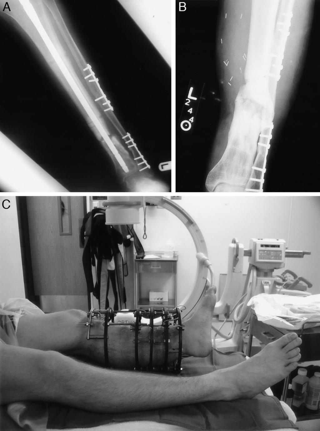 Treatment of Infected Tibial Nonunions 733 Fig. 3. Patient 9. (A) X-ray after realignment of fracture, with the tibia showing nonunion.