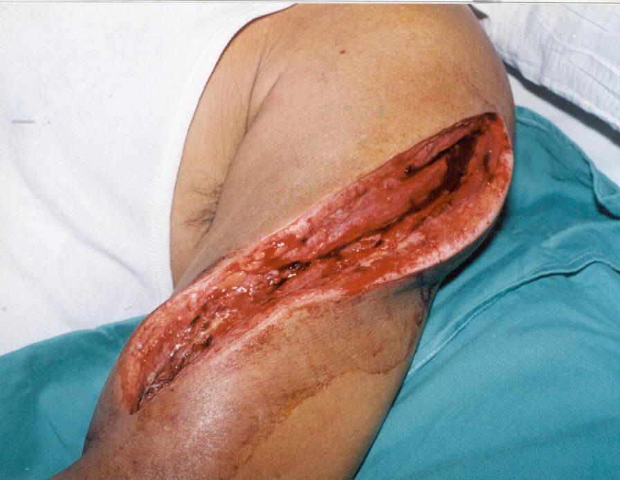 ( Week 1): 40 years old male; traumatic laceration on the lateral aspect upper arm; 10X 5cm; 5 cm deep. Painful.